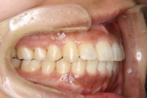 矯正歯科治療後の右側面です。円山桜木矯正歯科にて治療。